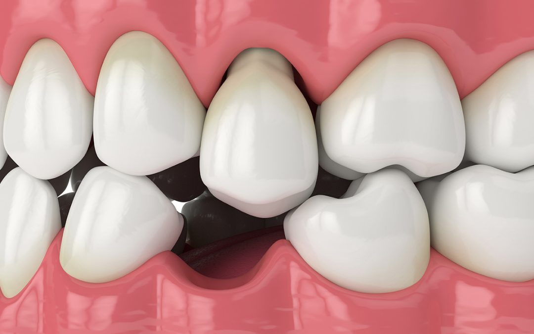 What are the options for replacing missing teeth, and which is best for me?