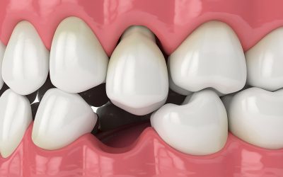 What are the options for replacing missing teeth, and which is best for me?