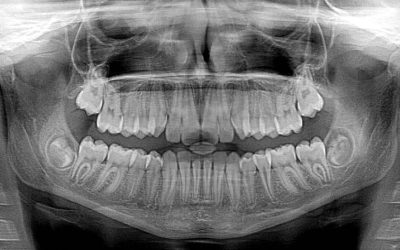 Are dental X-rays safe, and how often should they be taken?