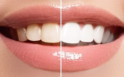 Is teeth whitening safe, and how can I whiten my teeth effectively?
