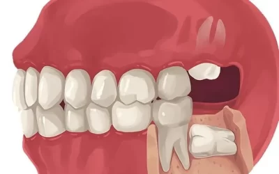 Do I need to get my wisdom teeth removed, and when is the right time?